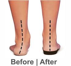 Image of leg before and after using arch support
