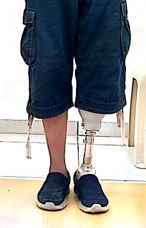 Image of a patient who is balancing his weight using a prosthetic leg